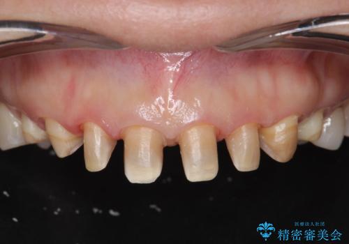 劣化してきた前歯ラミネートをジルコニアクラウンへの治療中