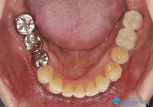 前歯のすれ違いによる歯周病を矯正治療で改善の治療後