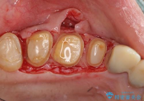 歯周外科で達成する安定したクラウン周囲の歯肉環境の治療前