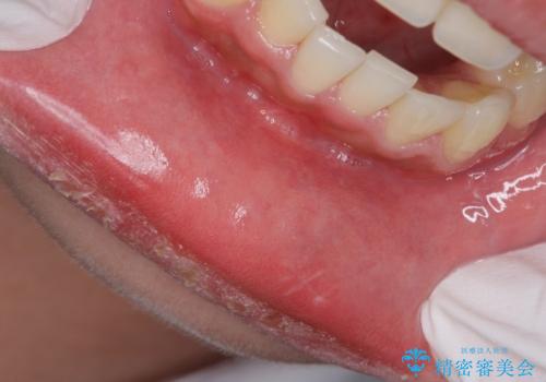 唇がたびたび腫れる 粘液嚢胞の摘出の症例 治療後