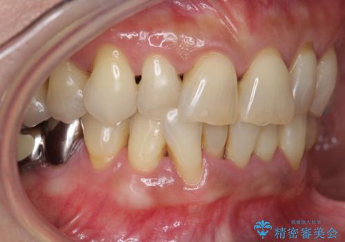 前歯のすれ違いによる歯周病を矯正治療で改善の治療前