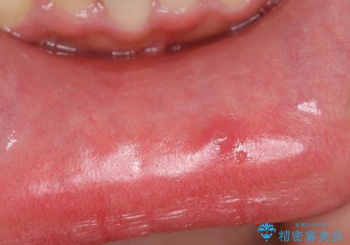 唇がたびたび腫れる　粘液嚢胞の摘出の治療前