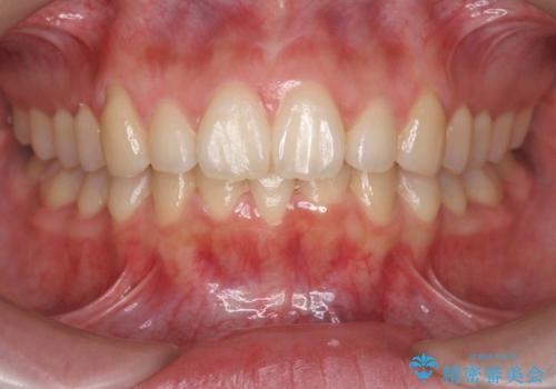 マウスピースで出っ歯感の改善の症例 治療後