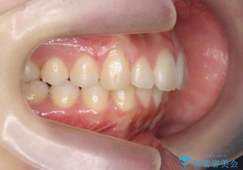 マウスピースで出っ歯感の改善の治療後