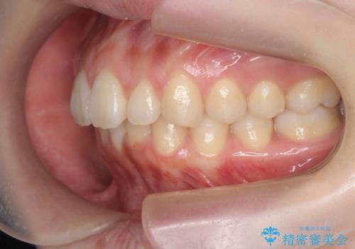マウスピースで出っ歯感の改善の治療後