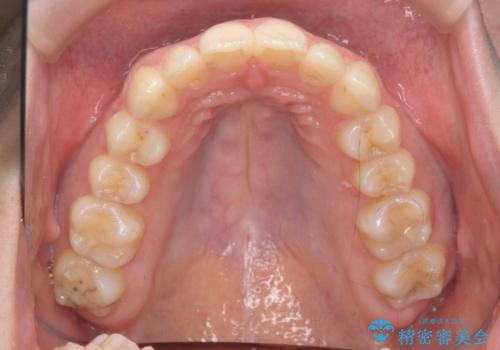 マウスピースで出っ歯感の改善の治療後