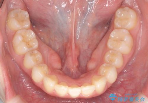 マウスピースで出っ歯感の改善の治療後