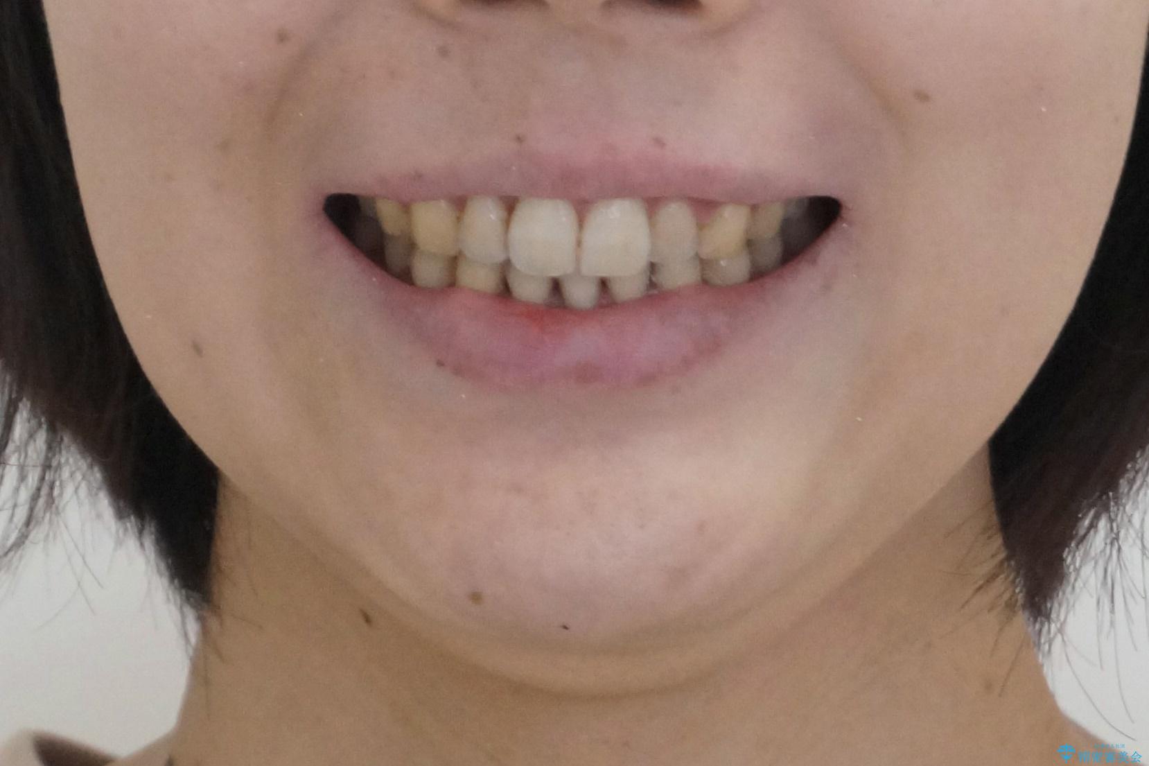 前歯のガタつき インビザラインで 下の前歯を1本抜歯の治療後(顔貌)