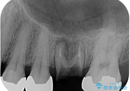 欠損と痛み 奥歯のむし歯治療の治療前