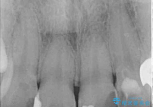 つぎはぎの前歯をセラミックにしたいの治療前