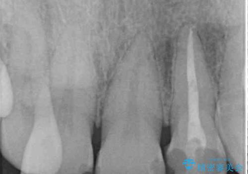 変色した前歯をオールセラミッククラウンで自然な口元にの治療前