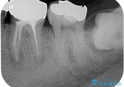 欠損と痛み 奥歯のむし歯治療の治療前