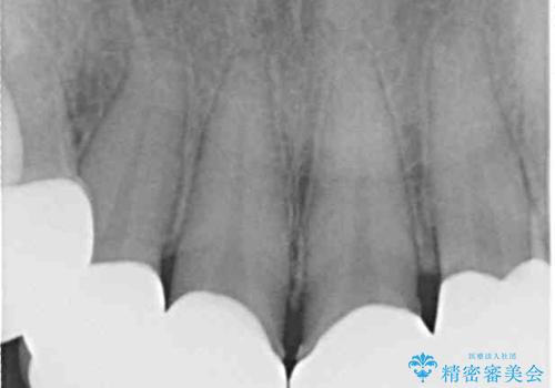 八重歯と形の悪い前歯 矯正治療とセラミック治療の治療後