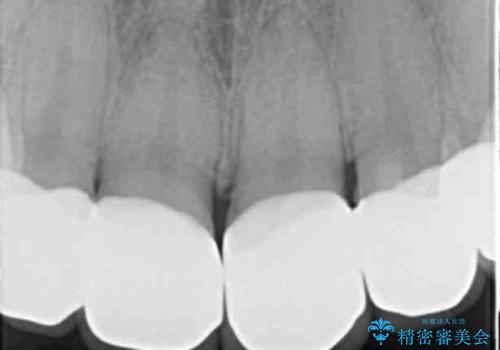 つぎはぎの前歯をセラミックにしたいの治療後