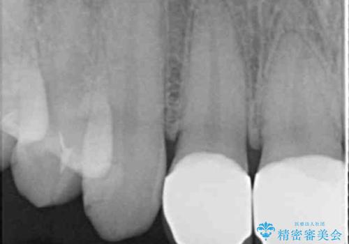 つぎはぎの前歯をセラミックにしたいの治療後