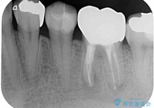 欠損と痛み 奥歯のむし歯治療の治療後