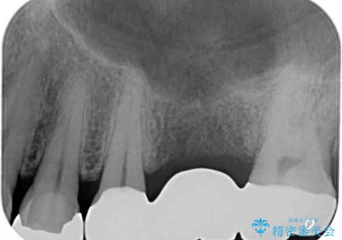 欠損と痛み 奥歯のむし歯治療の治療後