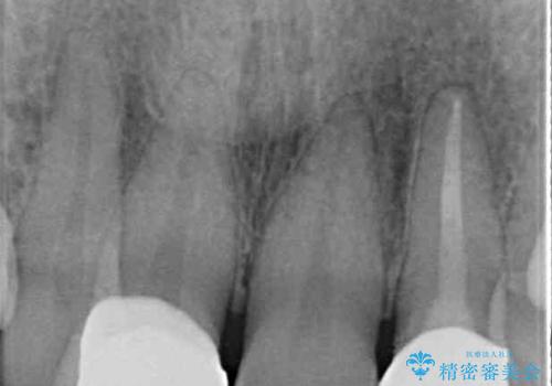 変色した前歯をオールセラミッククラウンで自然な口元にの治療後