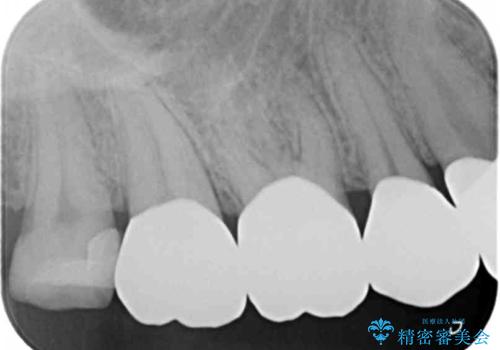 歯周外科で達成する安定したクラウン周囲の歯肉環境の治療後