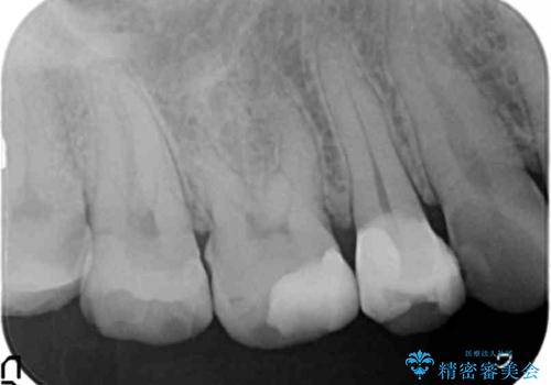 歯周外科で達成する安定したクラウン周囲の歯肉環境の治療前