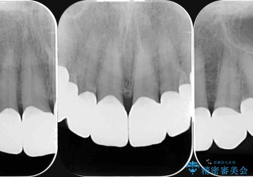 劣化してきた前歯ラミネートをジルコニアクラウンへの治療後