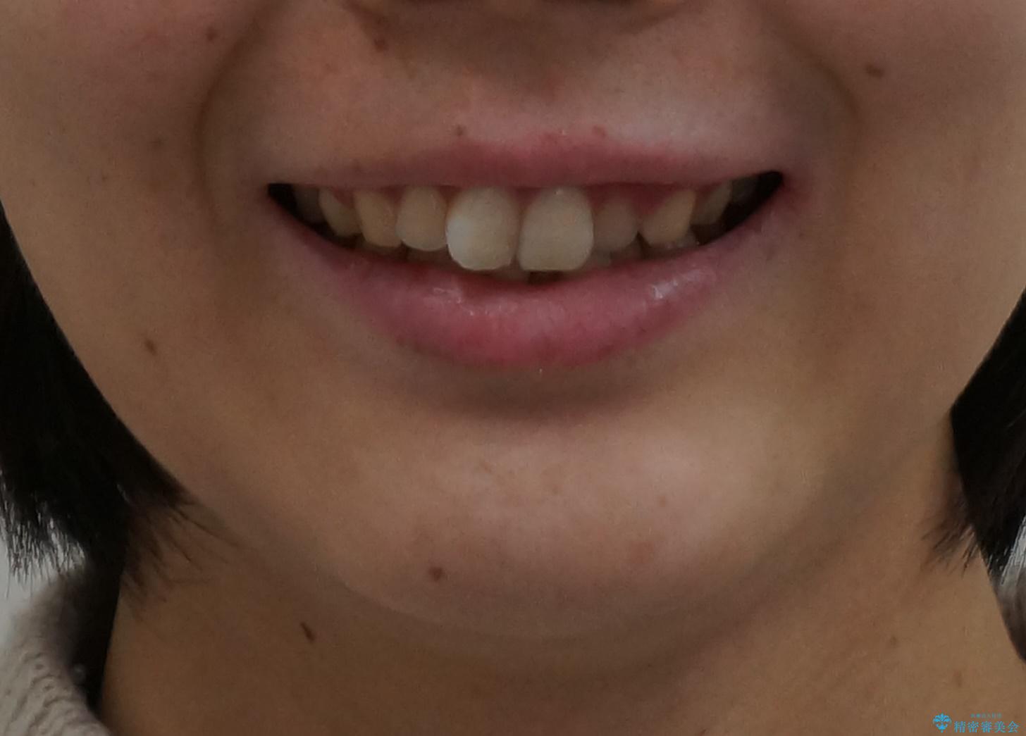 前歯のガタつき　インビザラインで　下の前歯を1本抜歯の治療前（顔貌）