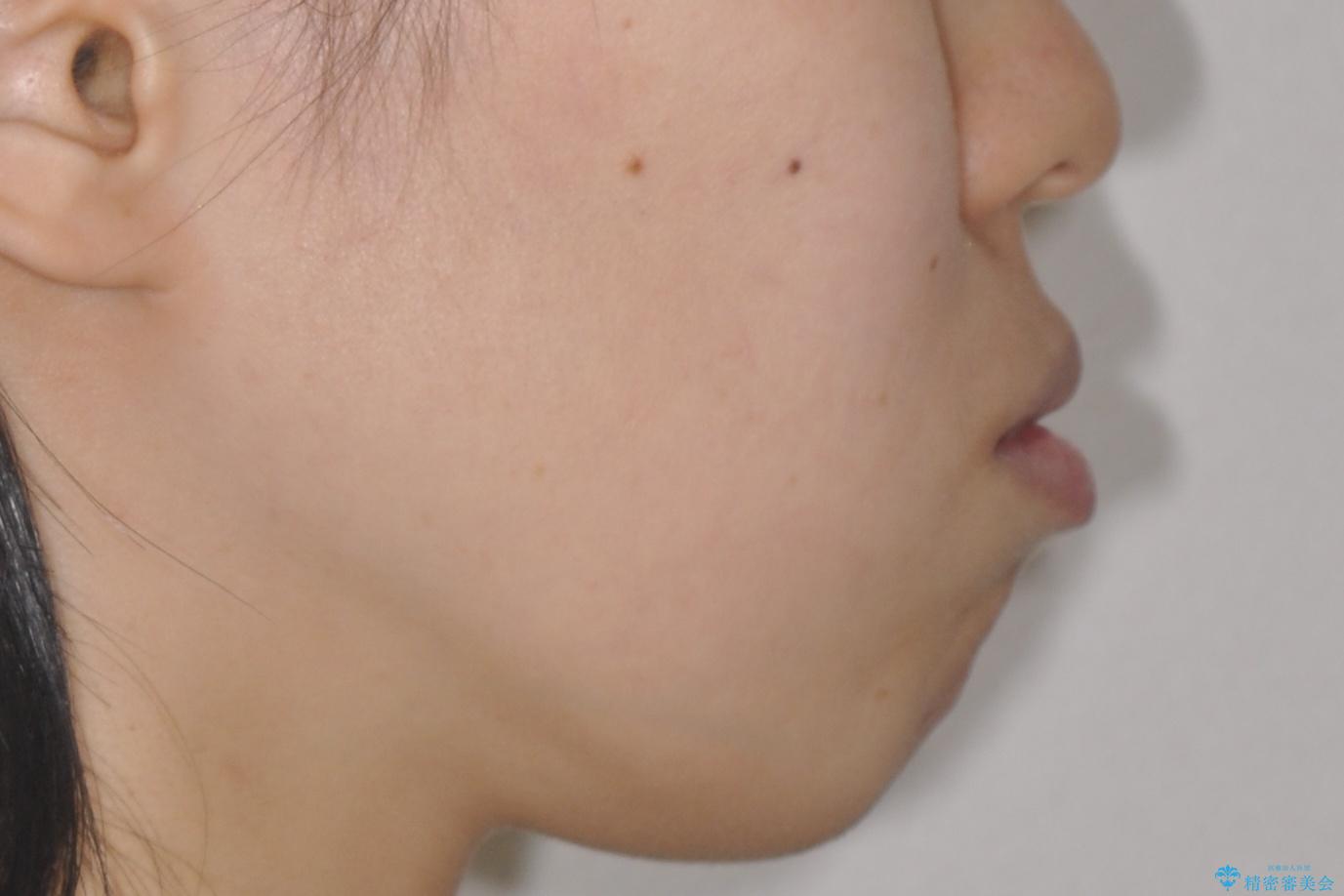 【審美ワイヤー】口ボコをなおしたいの治療前(顔貌)