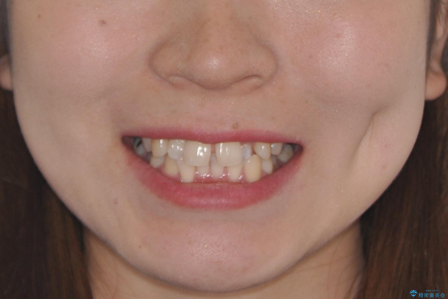 【すきっ歯・引っ込んだ前歯でお悩みの方必見】インビザライン矯正の症例の治療前（顔貌）
