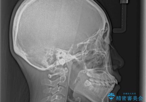 口元を引っ込めたい 目立たないワイヤー装置での抜歯矯正の治療前