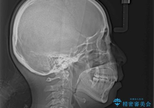 Eラインを改善したい ハーフリンガルによる抜歯矯正の治療後