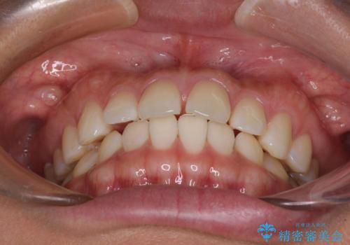 【モニター】前歯のすきっ歯をインビザラインで改善の治療前