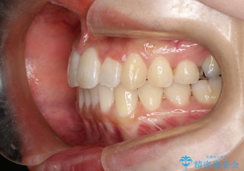 【すきっ歯・引っ込んだ前歯でお悩みの方必見】インビザライン矯正の症例の治療後