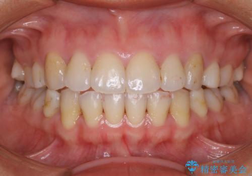 1年ぶりのクリーニング(PMTC)の症例 治療前