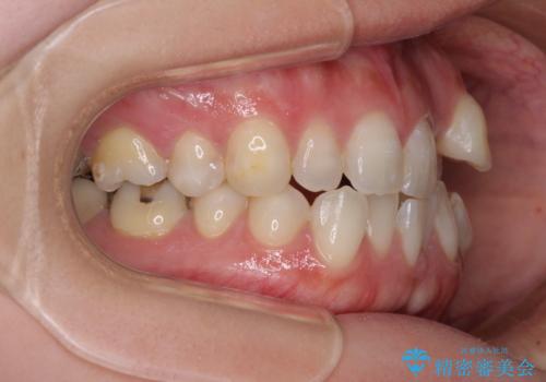 八重歯と前歯の欠損と骨格のズレ 目立たないワイヤー矯正の治療前