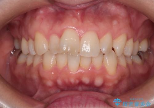 【インビザライン 】前歯のガタガタを治したいの治療前