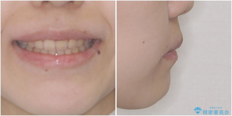 口元を引っ込めたい　目立たないワイヤー装置での抜歯矯正の治療後（顔貌）