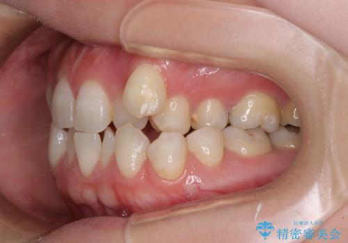 八重歯と前歯の欠損と骨格のズレ 目立たないワイヤー矯正の治療前