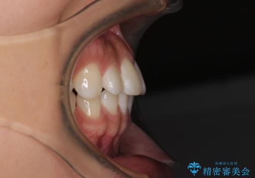 【モニター】前歯のすきっ歯をインビザラインで改善の治療前