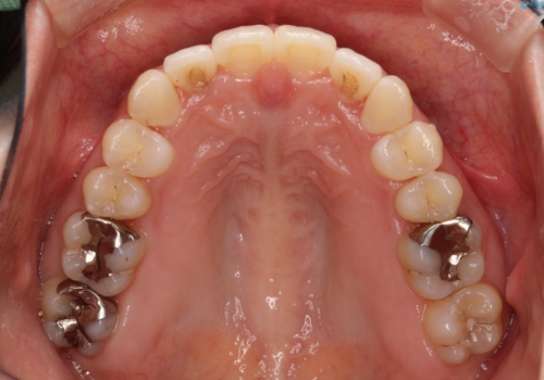 【すきっ歯・引っ込んだ前歯でお悩みの方必見】インビザライン矯正の症例の治療後
