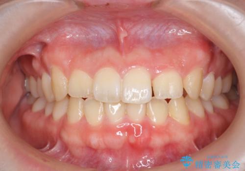 前歯のねじれを治したい (部分矯正を併用したマウスピース矯正)の治療中