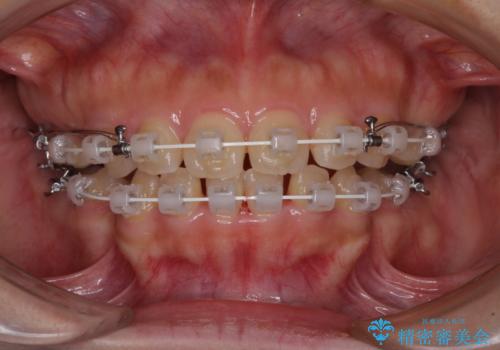 口元を引っ込めたい 目立たないワイヤー装置での抜歯矯正の治療中