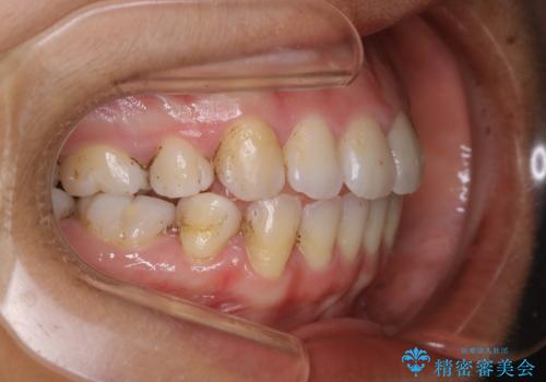 1年ぶりのクリーニング(PMTC)の治療前