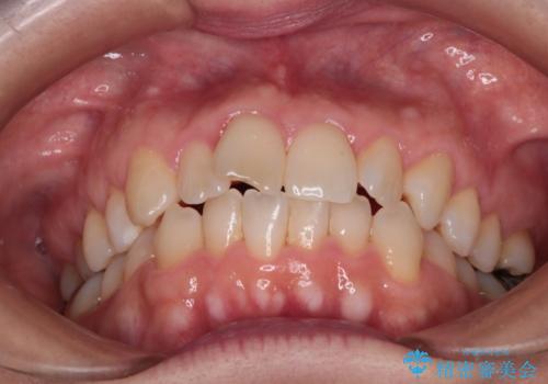 【インビザライン 】前歯のガタガタを治したいの治療前