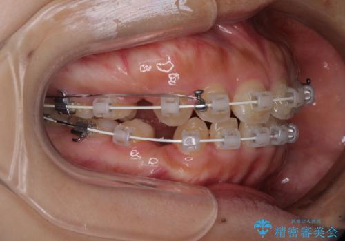 口元を引っ込めたい　目立たないワイヤー装置での抜歯矯正の治療中