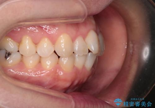 【インビザライン 】前歯のガタガタを治したいの治療前
