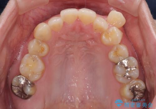 八重歯と前歯の欠損と骨格のズレ 目立たないワイヤー矯正の治療前