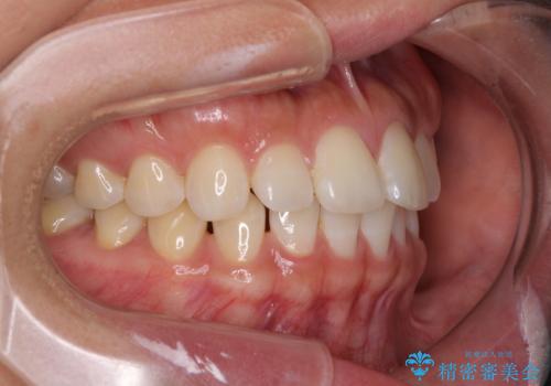 【モニター】前歯のすきっ歯をインビザラインで改善の治療前