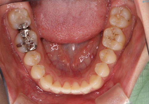 【すきっ歯・引っ込んだ前歯でお悩みの方必見】インビザライン矯正の症例の治療後