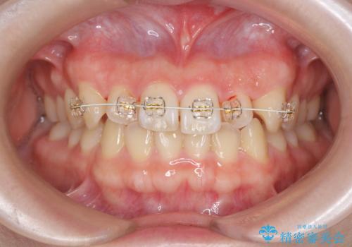 前歯のねじれを治したい (部分矯正を併用したマウスピース矯正)の治療中
