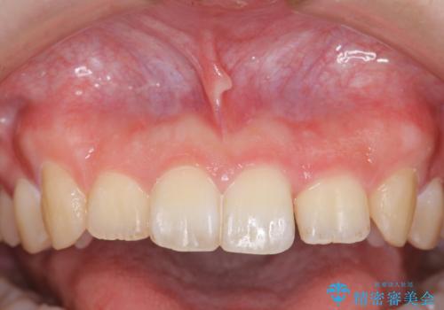 前歯のねじれを治したい (部分矯正を併用したマウスピース矯正)の治療中